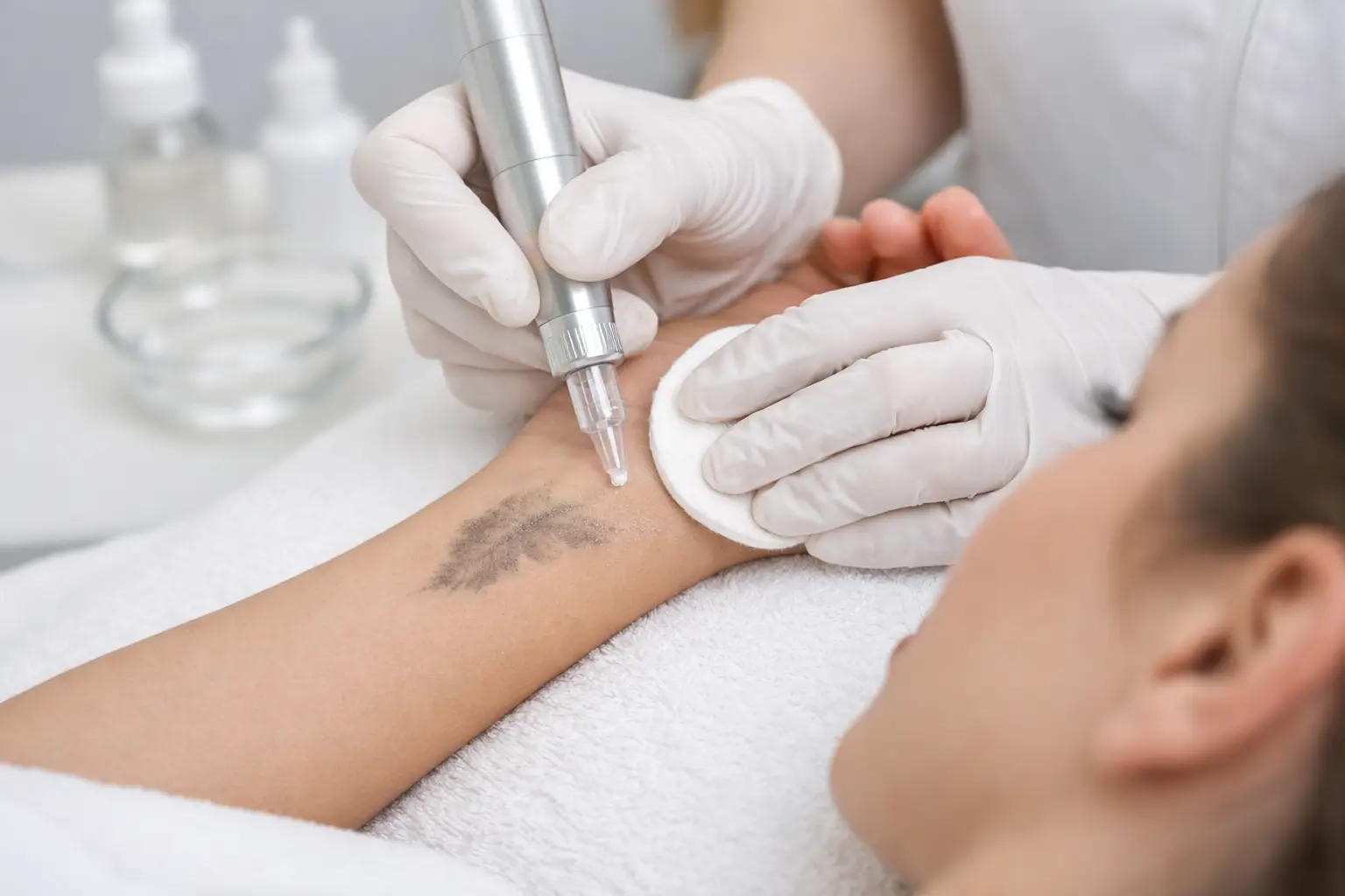 Guide to Saline Tattoo Removal: What to Expect